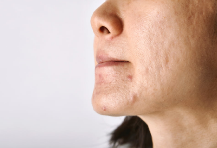 Best Acne Scar Treatment: Proven Medical and At-Home Options Reviewed
